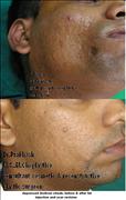 Before After Pictures,Cosmetic surgery,Delhi, fat injection , cheek